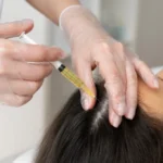 prp treatment of hair