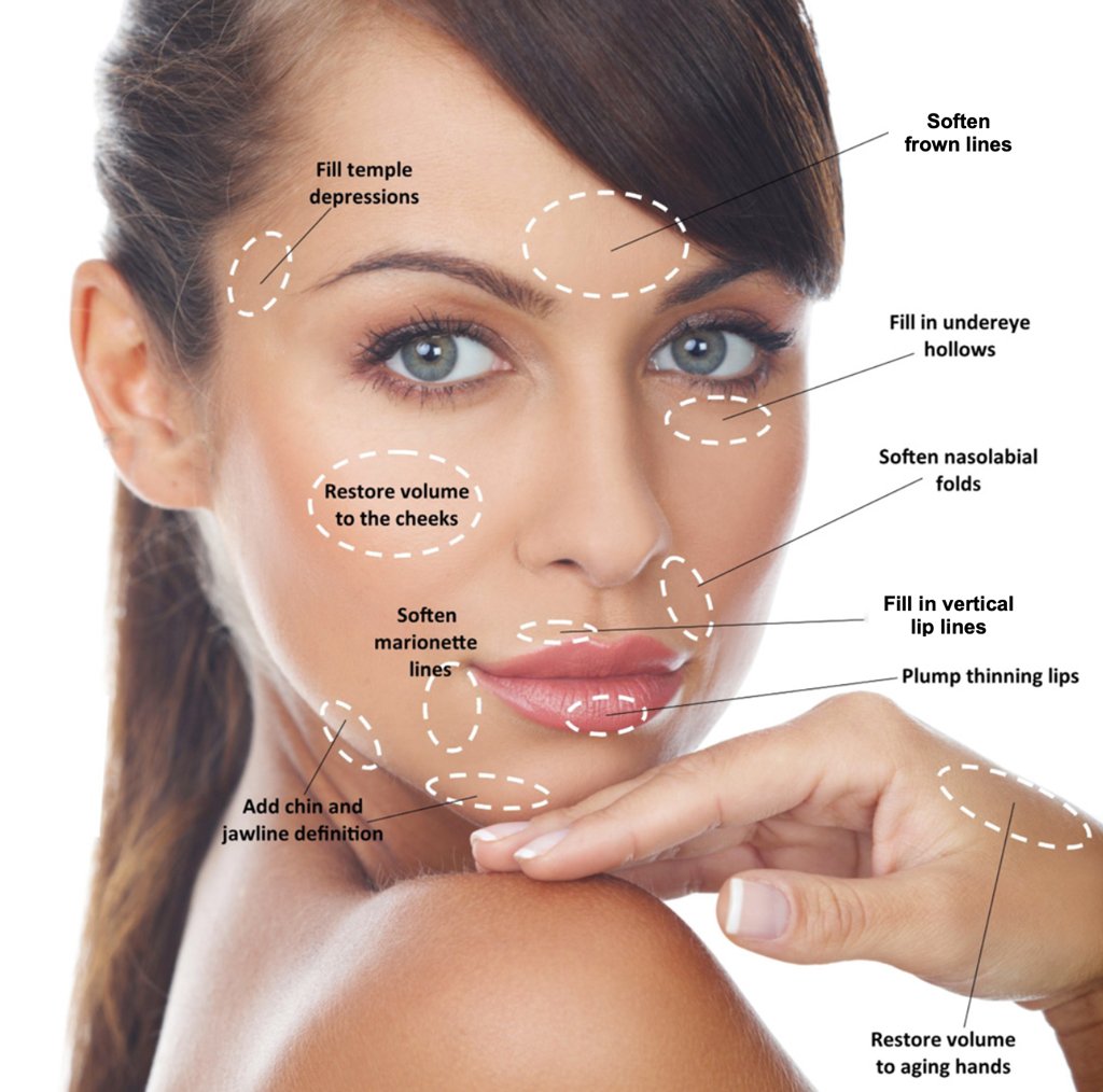 dermal filler skin bliss